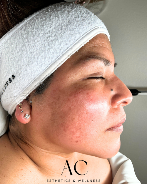 After Treatment