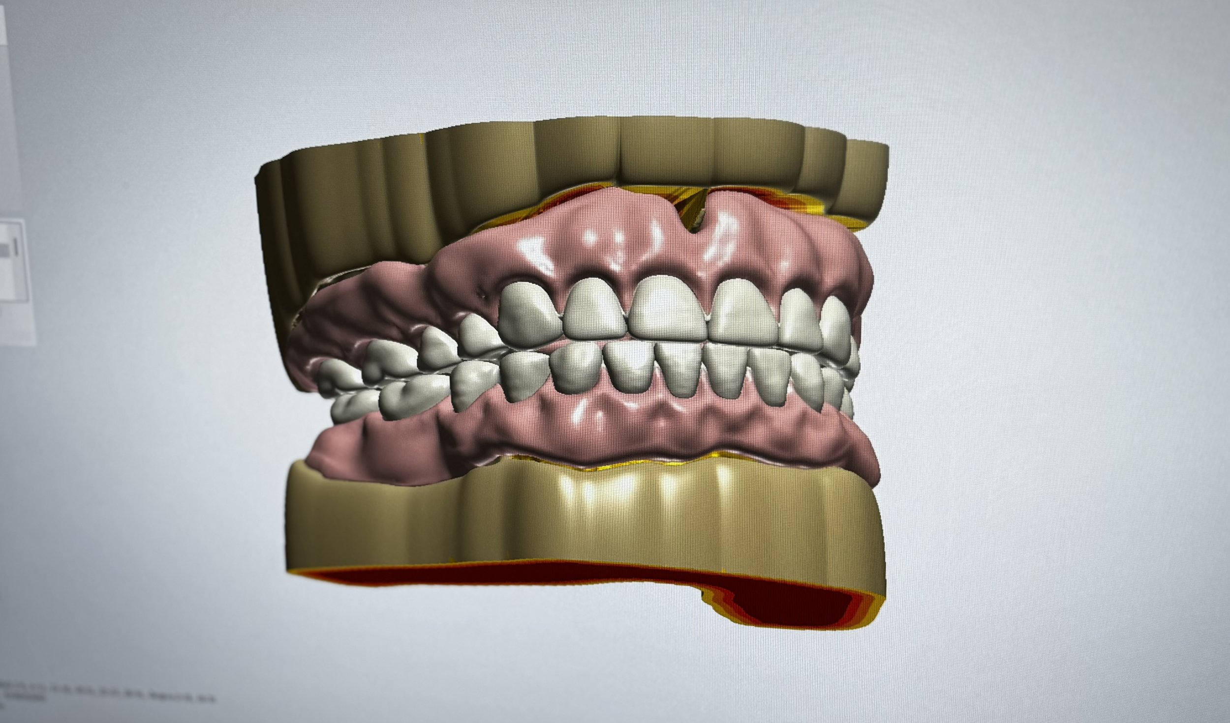 Digital Denture
