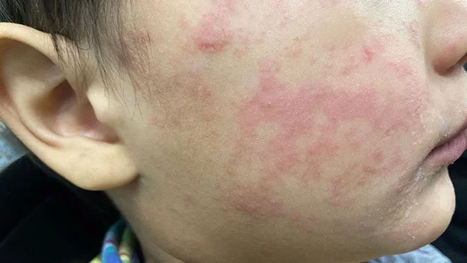 Close-up of a child's face showing red, inflamed skin and rash from measles