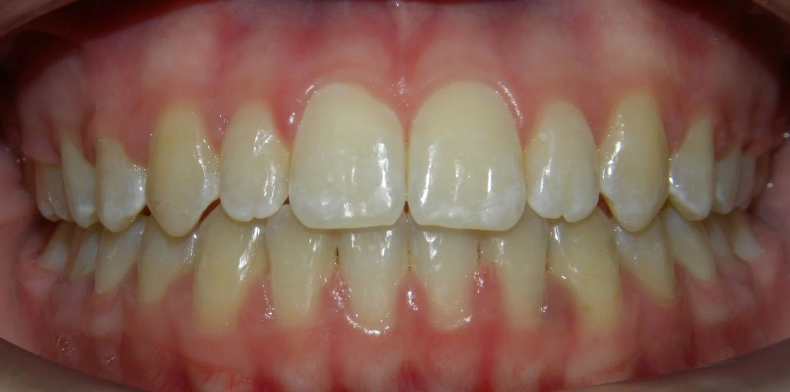 Close-up of upper and lower teeth showing misalignment and yellowish coloration