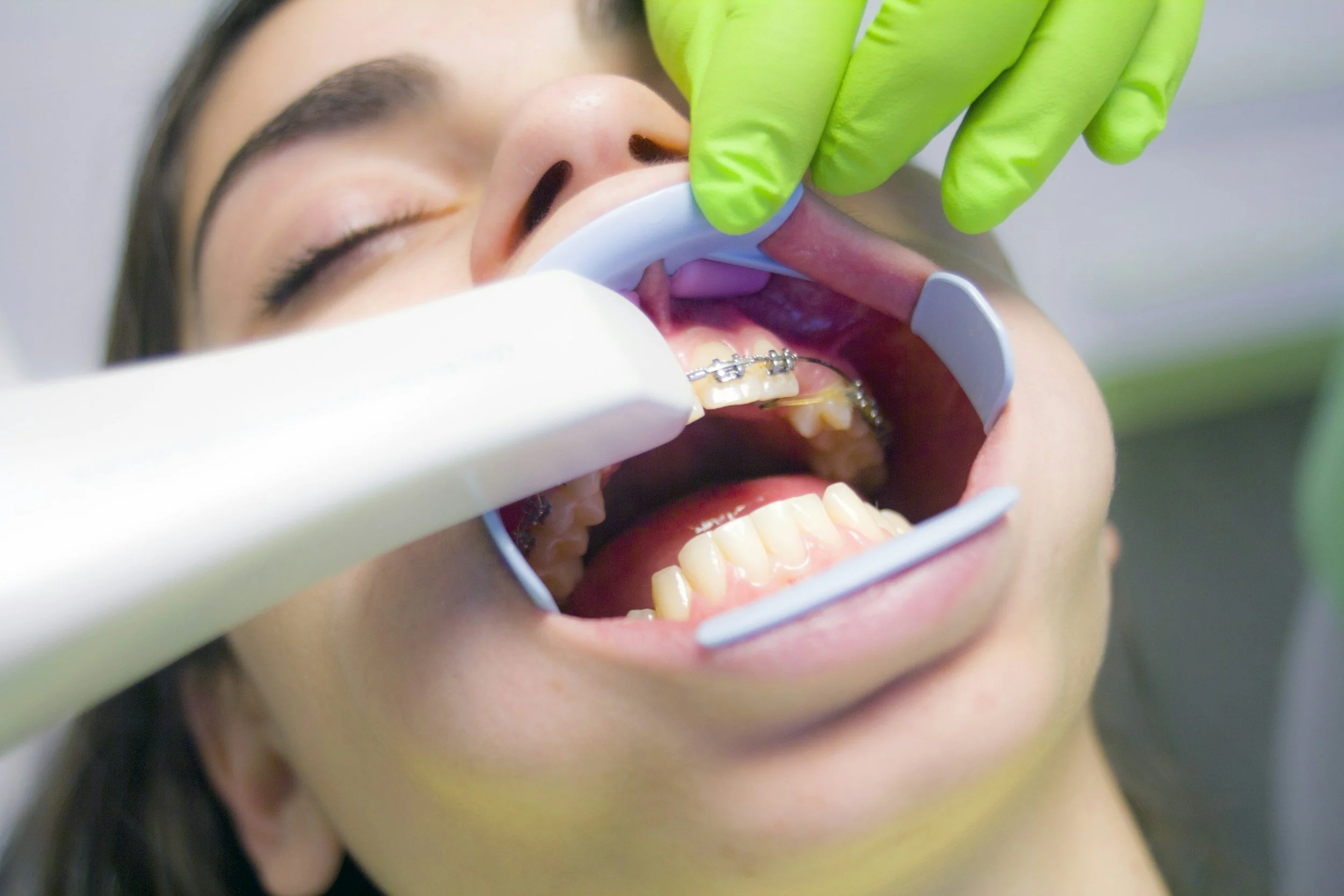Dental patient with braces undergoing an oral exam using a mirror and a dental curing light, wearing a dental bib and gloves in a dental clinic.