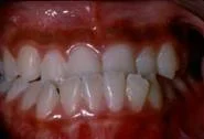 Close-up of a person's smile showing upper and lower teeth with some crowding.
