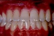 Close-up of a person's mouth showing upper and lower teeth with red gums.