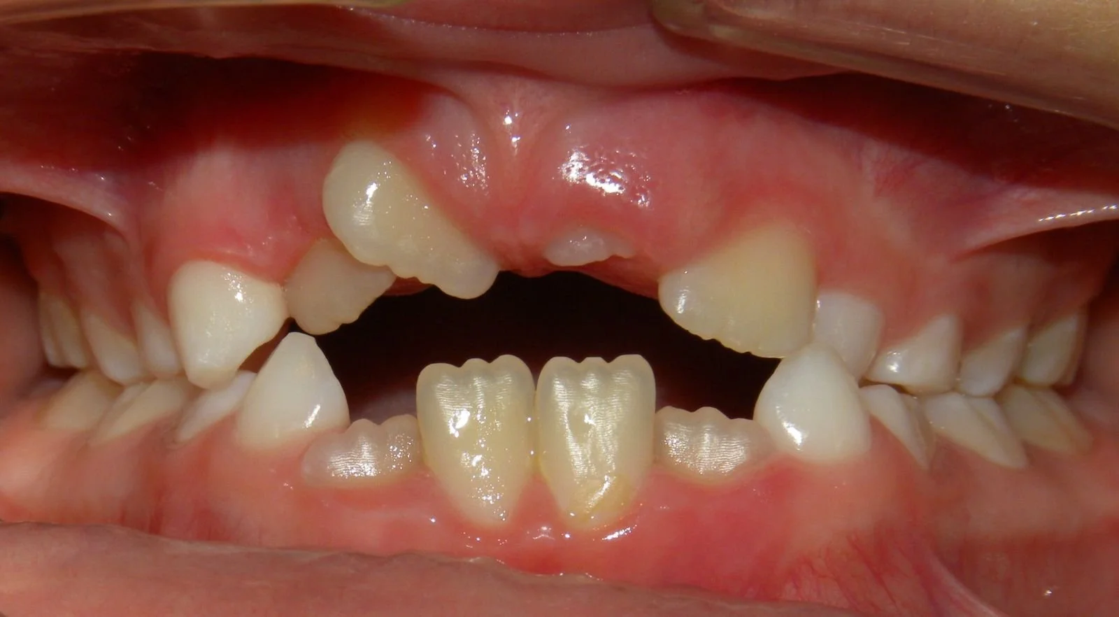 Child's mouth with missing and misaligned teeth, showing dental crowding and gaps.
