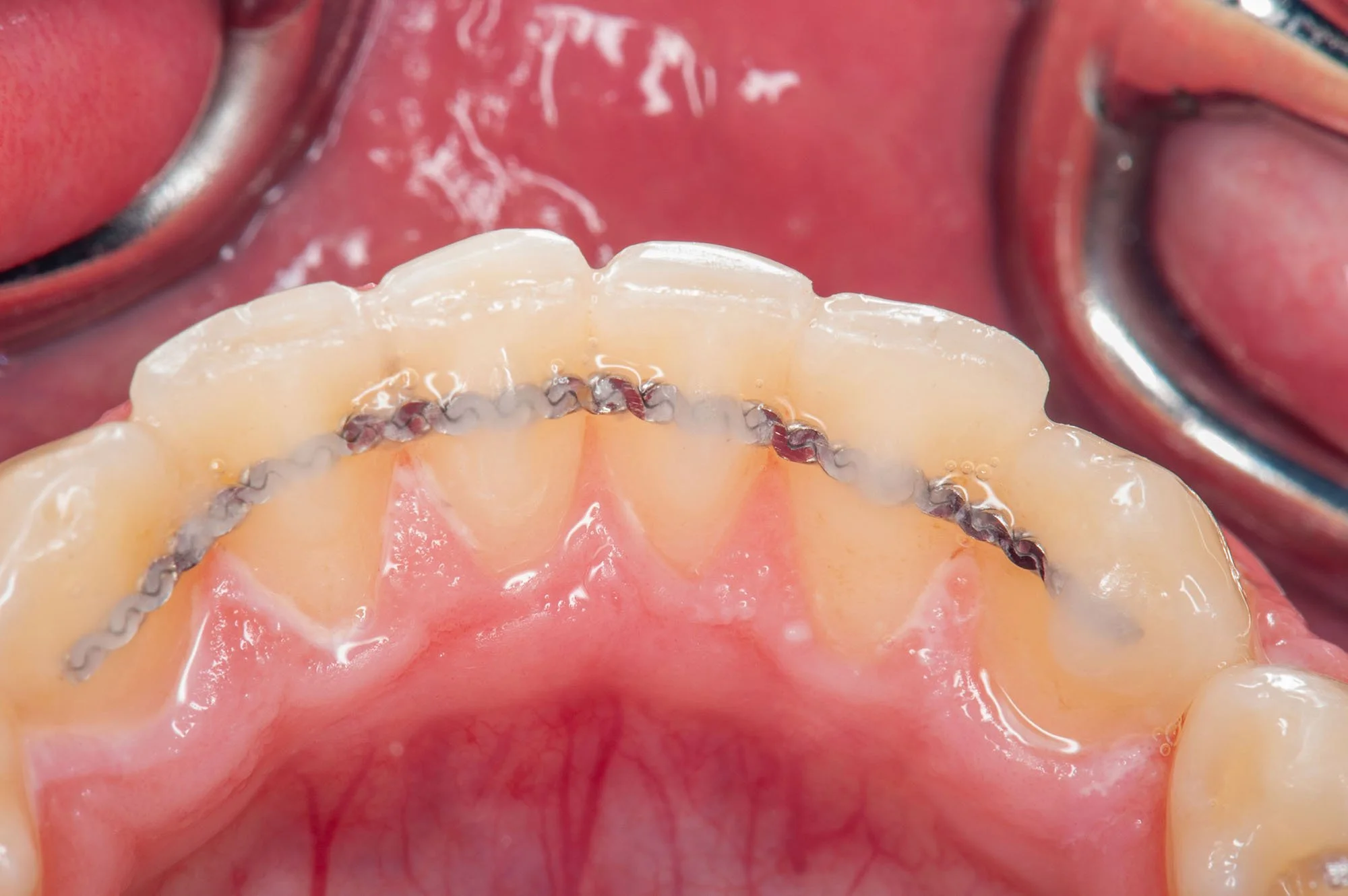 Close-up of a dental model showing a tooth-colored dental crown with a metal base on upper front teeth.