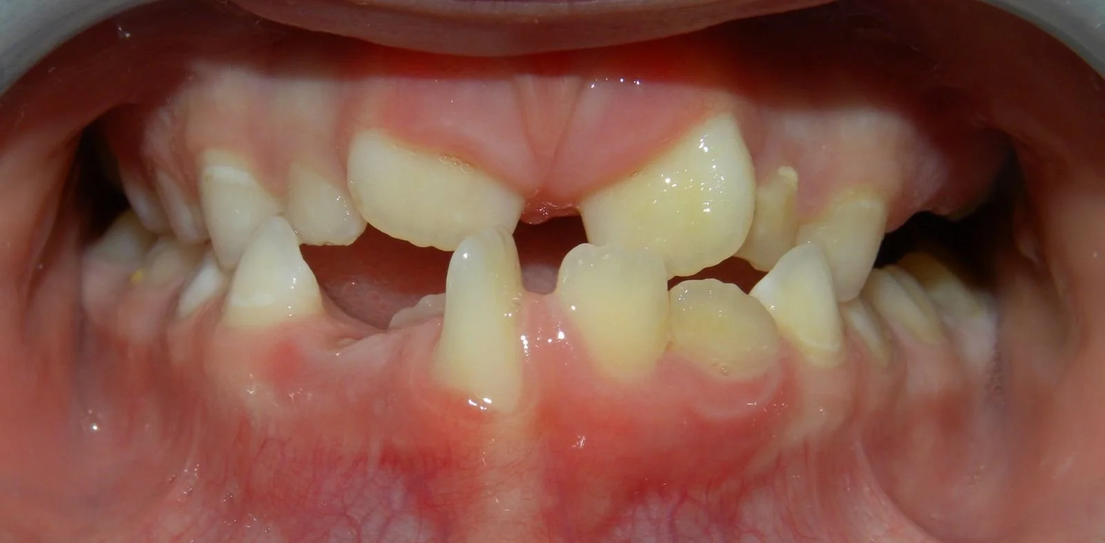Close-up of a child's mouth showing multiple crooked and decayed teeth with gaps and discoloration.