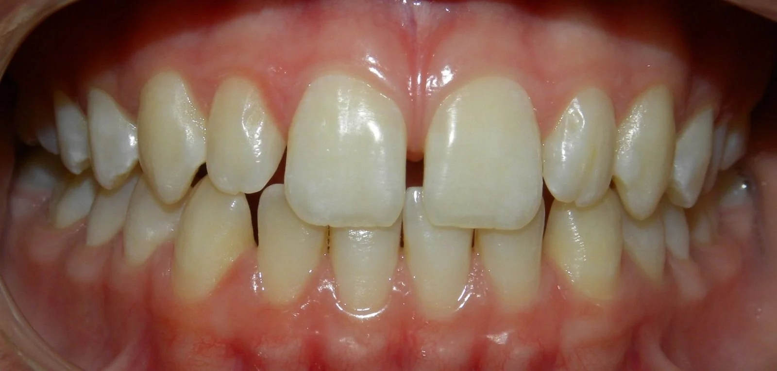 Close-up image of a set of upper and lower teeth with crowding and misalignment.