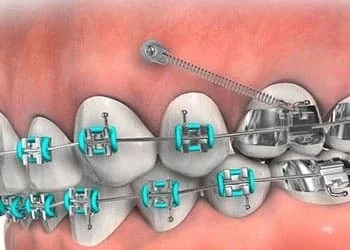 TADs (Temporary Anchorage Devices) -- Tiny screws placed in the mouth to help move specific teeth. They’re placed comfortably and need to be kept clean with gentle brushing and rinsing.