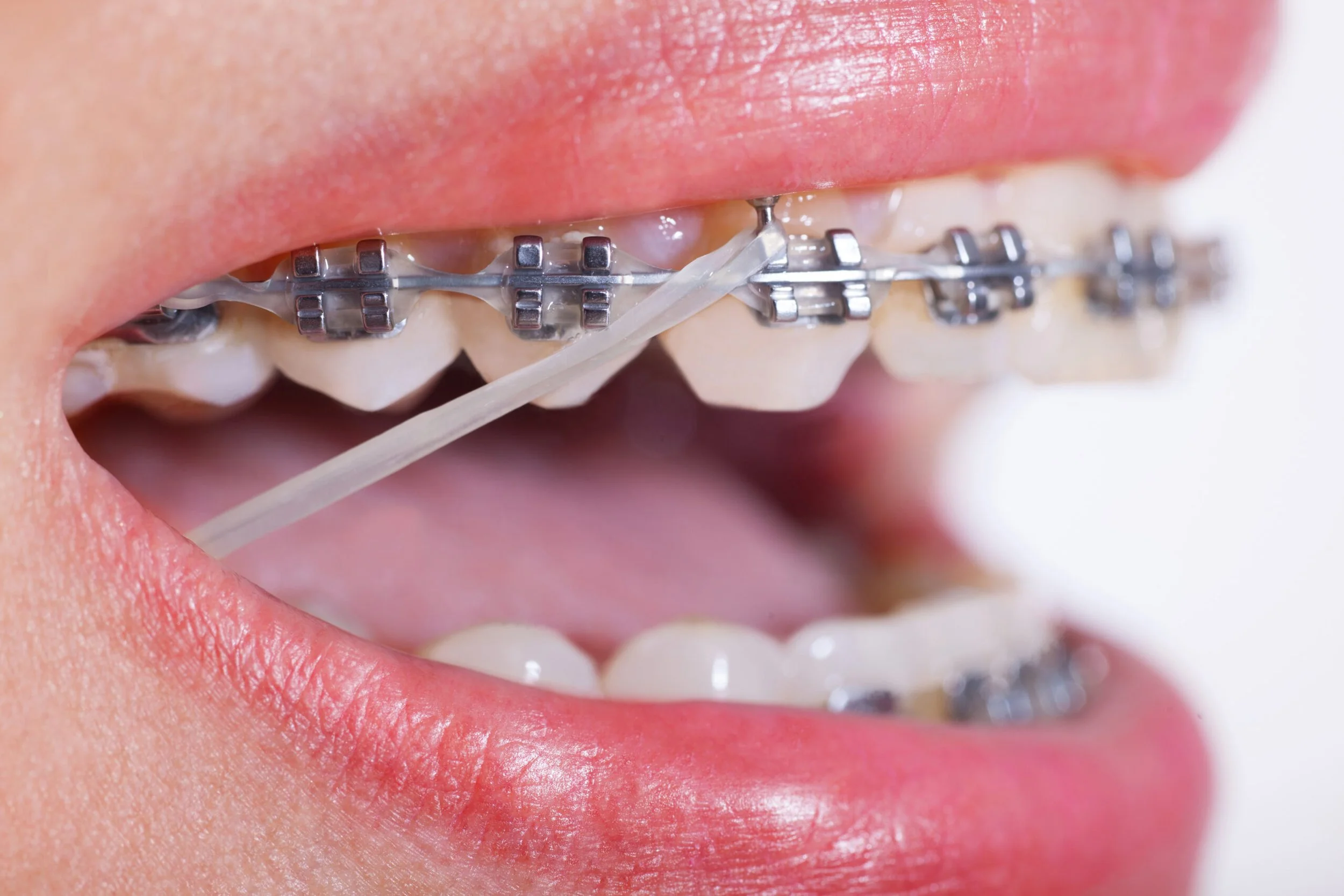 Elastics (Rubber Bands) -- Used to adjust your bite by connecting the top and bottom teeth. Wear them exactly as instructed for the best results, and replace them daily or as needed.