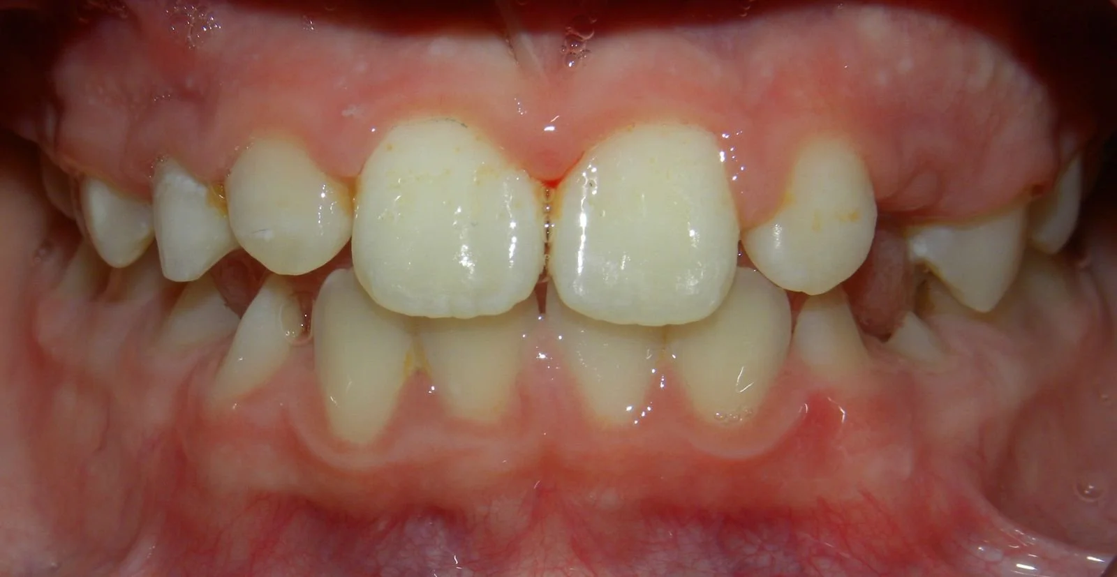 Close-up of a child's mouth with crooked, crowded, and misaligned teeth, some with plaque and yellowing.