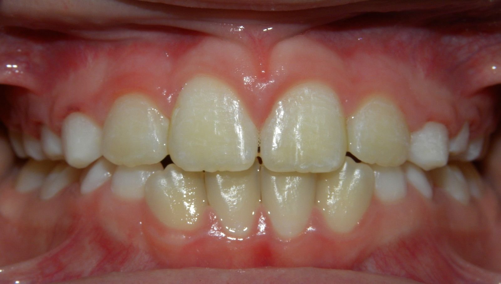 Close-up of a person's upper and lower teeth showing misalignment and discoloration.