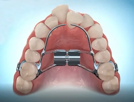 Palatal Expander -- Used to widen the upper jaw. We'll show you how to turn the key for adjustments — usually once a day. Keep it clean with rinsing and gentle brushing.