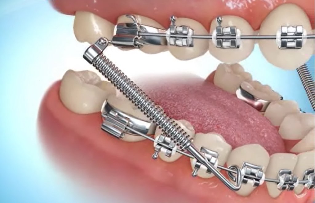 Forsus™ Appliance -- A spring-like appliance used to correct overbites without headgear. It’s fixed in place and works around the clock. Stick to soft foods at first and keep up with brushing.