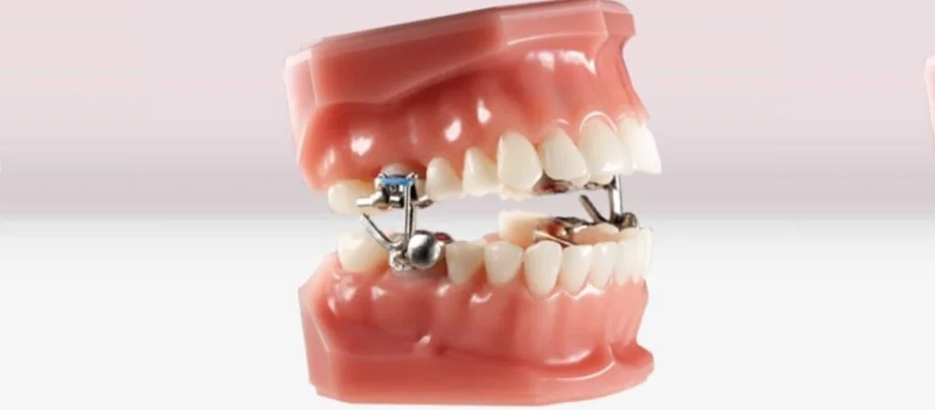 MARA Appliance -- A fixed appliance that helps shift the lower jaw forward to improve bite. It works full-time and requires good brushing habits, especially around the bands and arms.