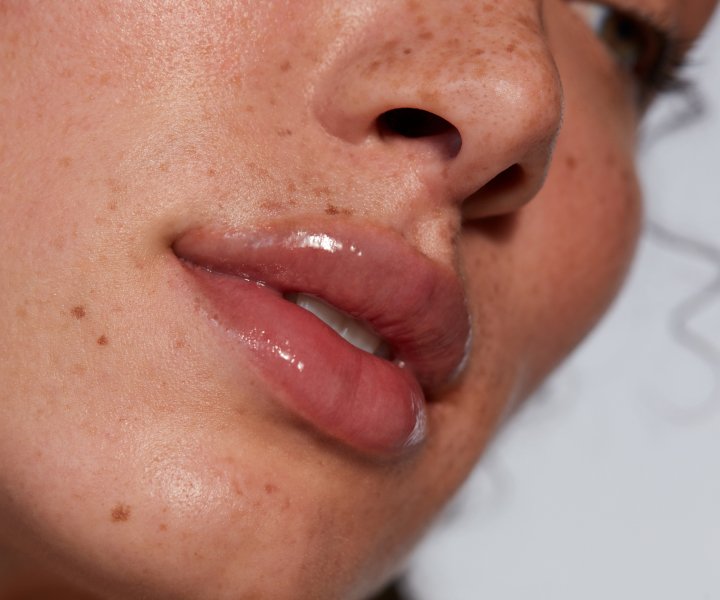 Lip Filler Treatment Natural Look