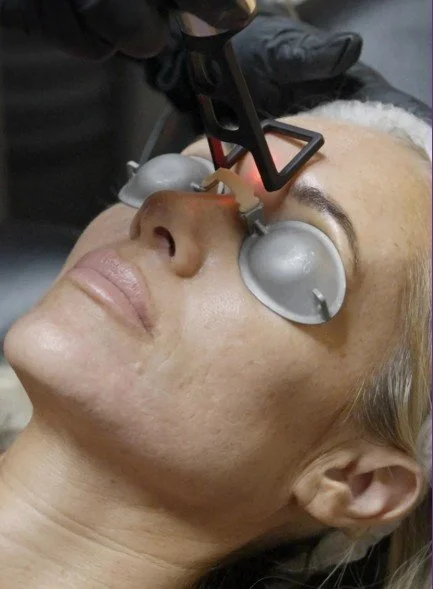 CoolPeel CO2 Laser Treatment