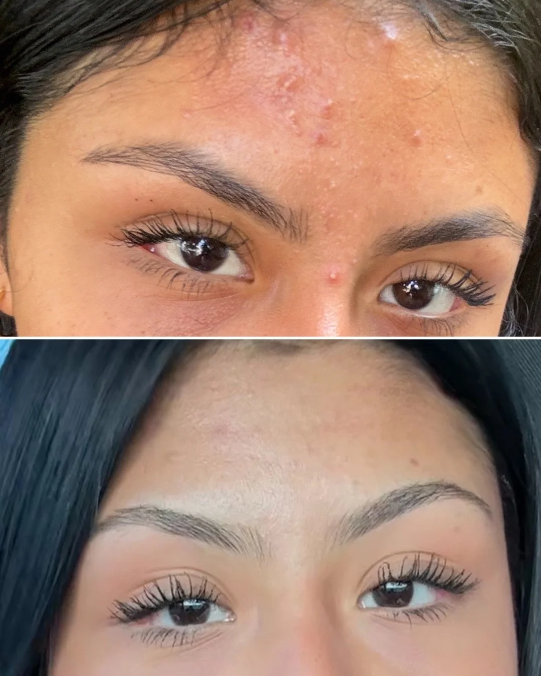 4 MONTH ACNE BOOTCAMP RESULTS 🩰🪞🕯️🦢

I am so proud of my sweet client for trusting me to guide her! You can see her complexion is brighter, happier, and healthier. Inflammation is down, breakouts are under control, and her texture? Improved by 10