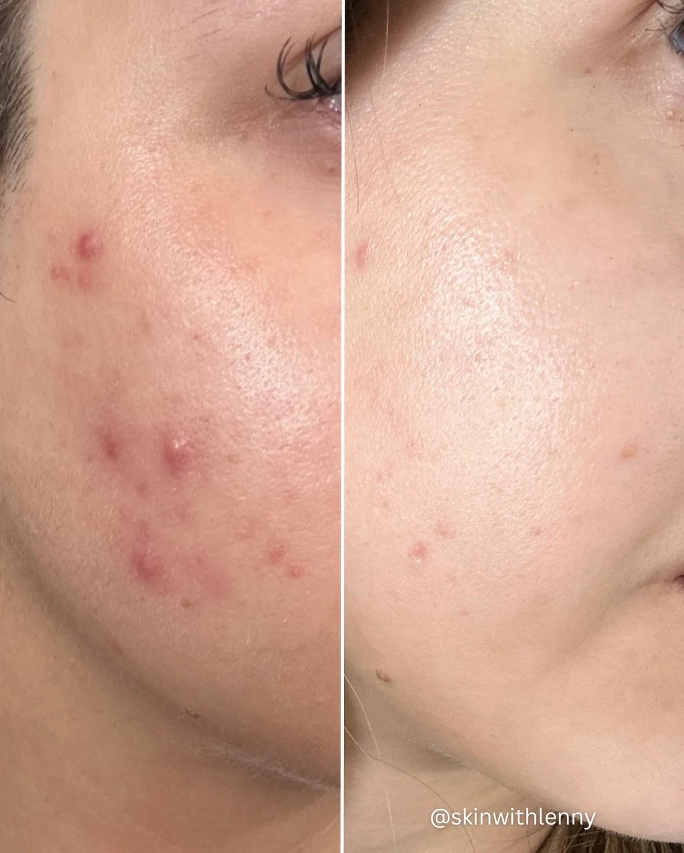 ANOTHER TRANSFORMATION 🫒🍸✨

acne is a chronic inflammatory condition, not a quick fix situation!! 

this transformation happened by calming inflammation, repairing the skin barrier, and staying consistent with a routine designed specifically for ac