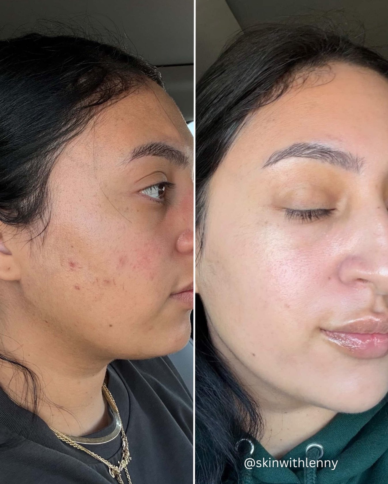 Another skin transformation with @facerealityskincare 👼🏼

This beautiful client came to me with acne rosacea, and through consistency, customized home care, and targeted treatments we were able to minimize her redness, smooth her texture, and clear