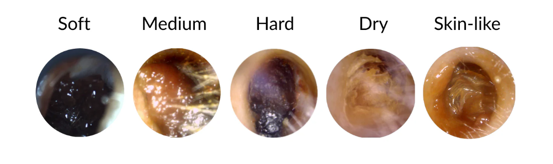 Diagram showing five stages of earwax consistency: soft, medium, hard, dry, and skin-like.