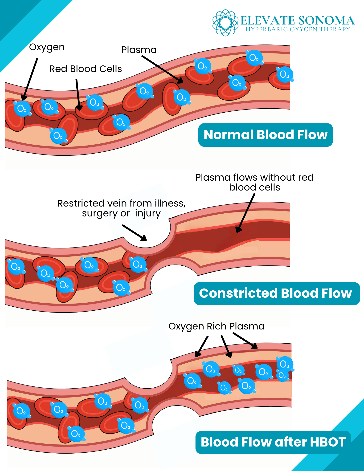 An illustration showing three stages of blood flow. The first labeled 'Normal Blood Flow' shows oxygen molecules moving freely with red blood cells through an open artery. The second labeled 'Constricted Blood Flow' depicts a narrowed artery due to i