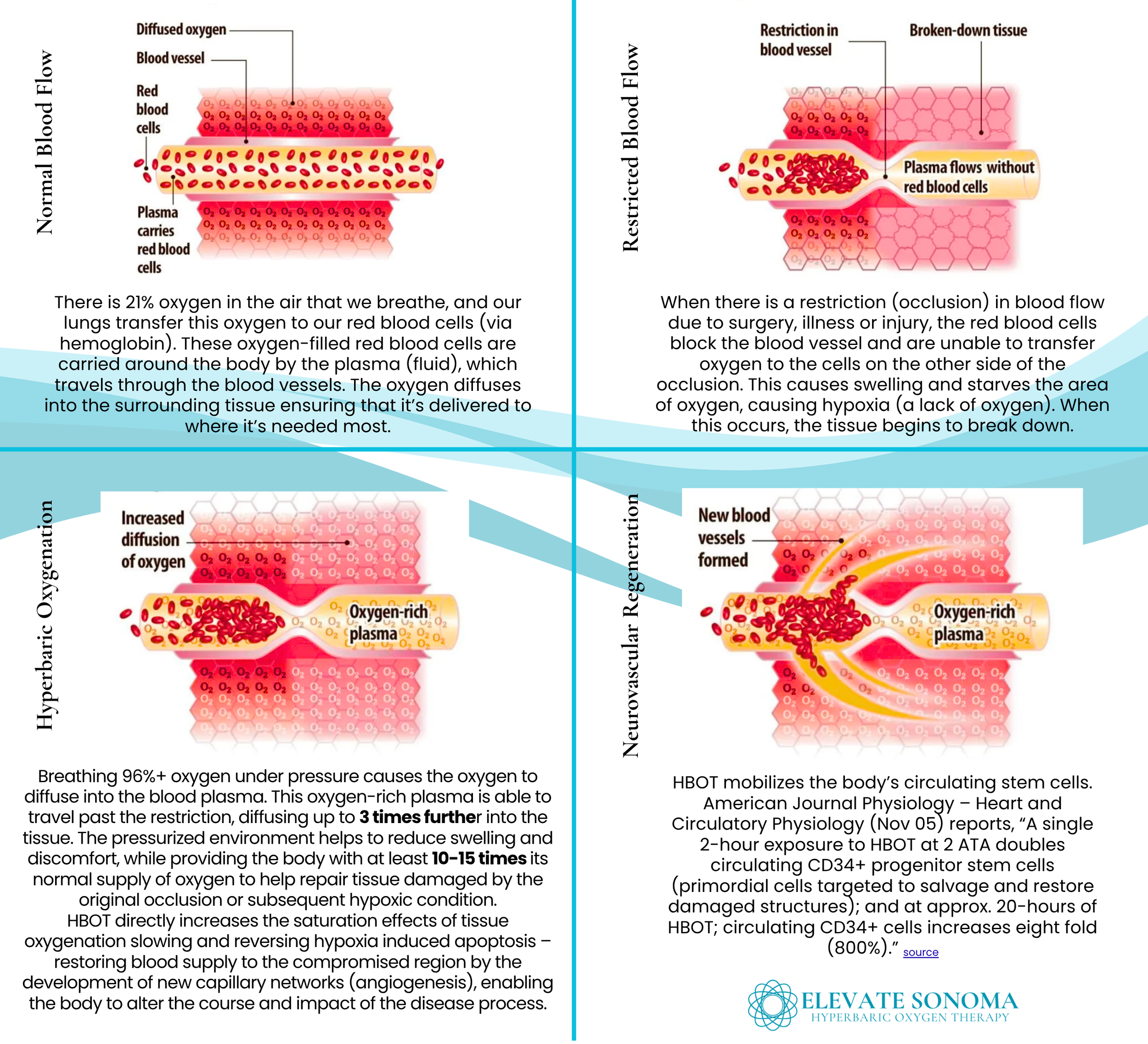 A four-part diagram illustrating the process of hyperbaric oxygen therapy. The first section shows normal blood flow with red blood cells carrying oxygen. The second section depicts restricted blood flow due to blood vessel obstruction, leading to tissue breakdown. The third section demonstrates increased oxygen diffusion into the tissue under high pressure, creating oxygen-rich plasma. The fourth section illustrates the formation of new blood vessels and tissue regeneration through neurovascular regeneration.
