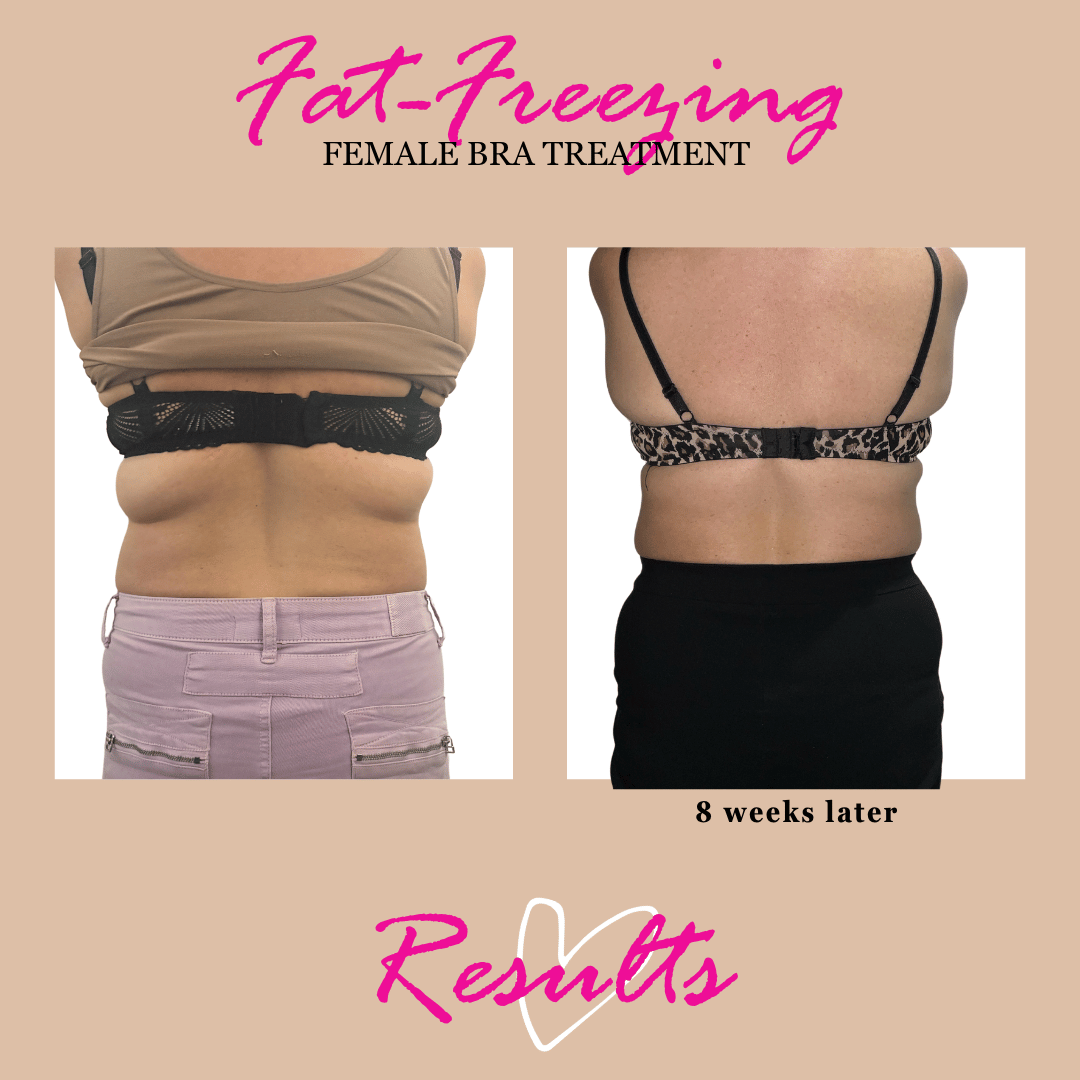 bra line fat freezing result at 8 weeks