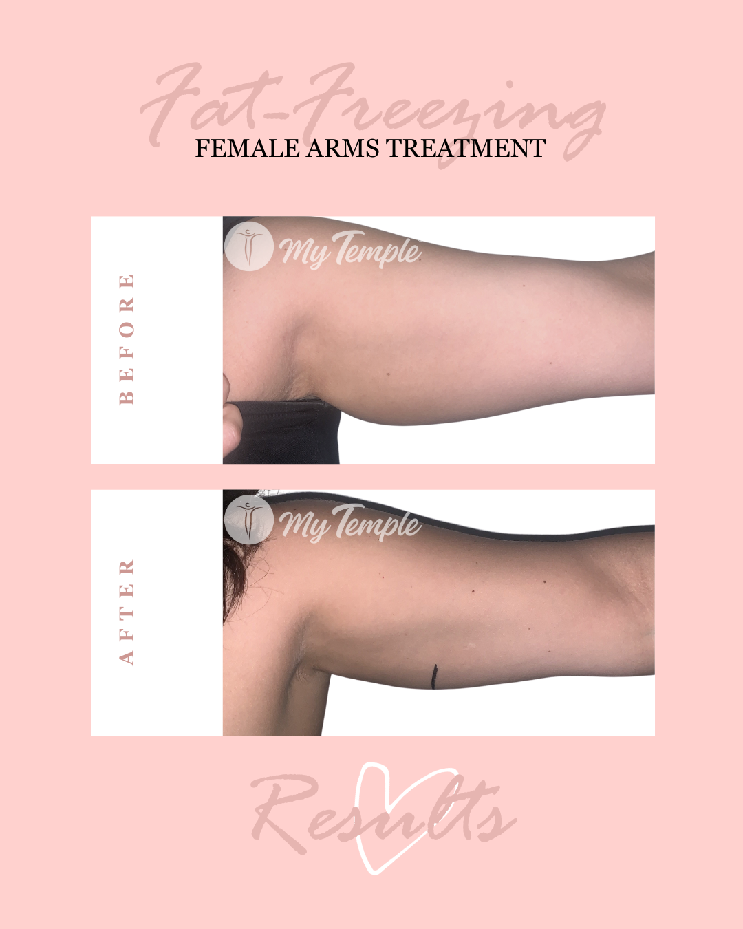Amanda Nonnis arms 2nd treatment 4x5.png