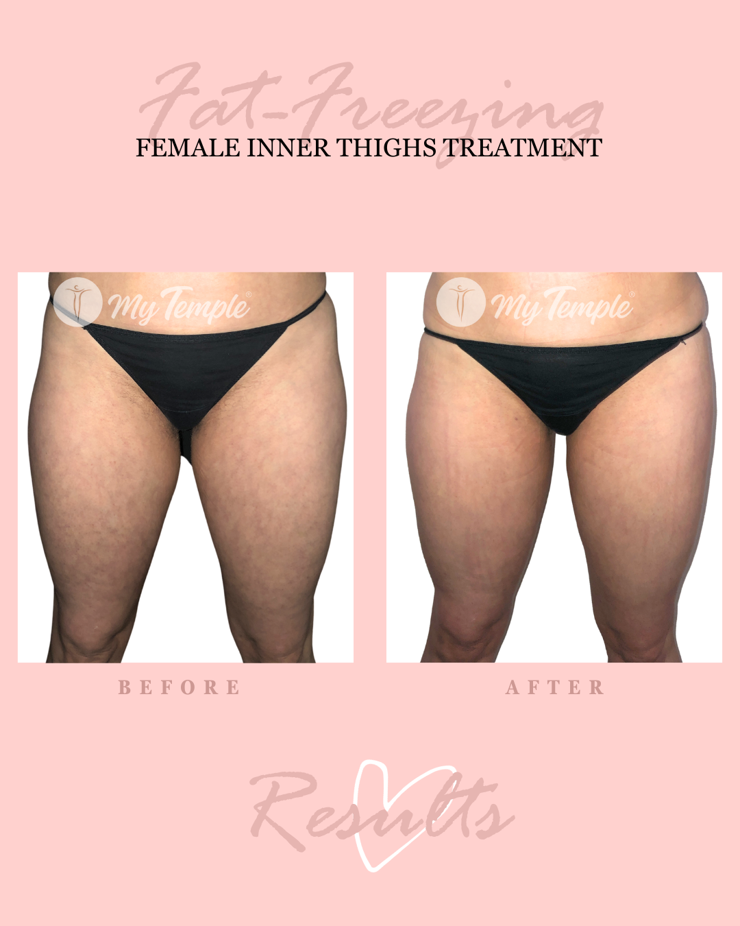 RF Inner Thigh 23 4x5 .png