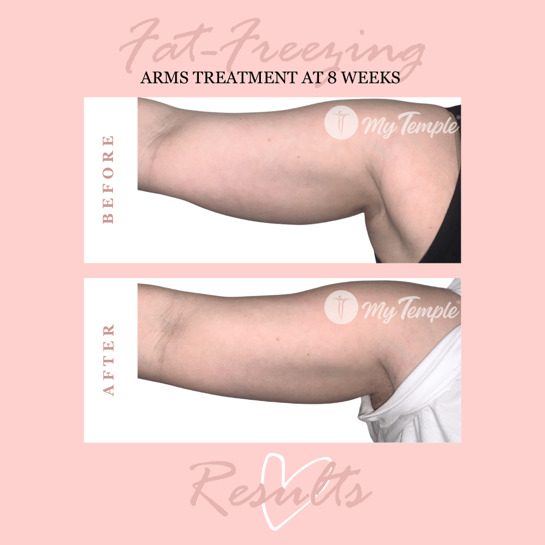 Jessica S arms 2 months.png