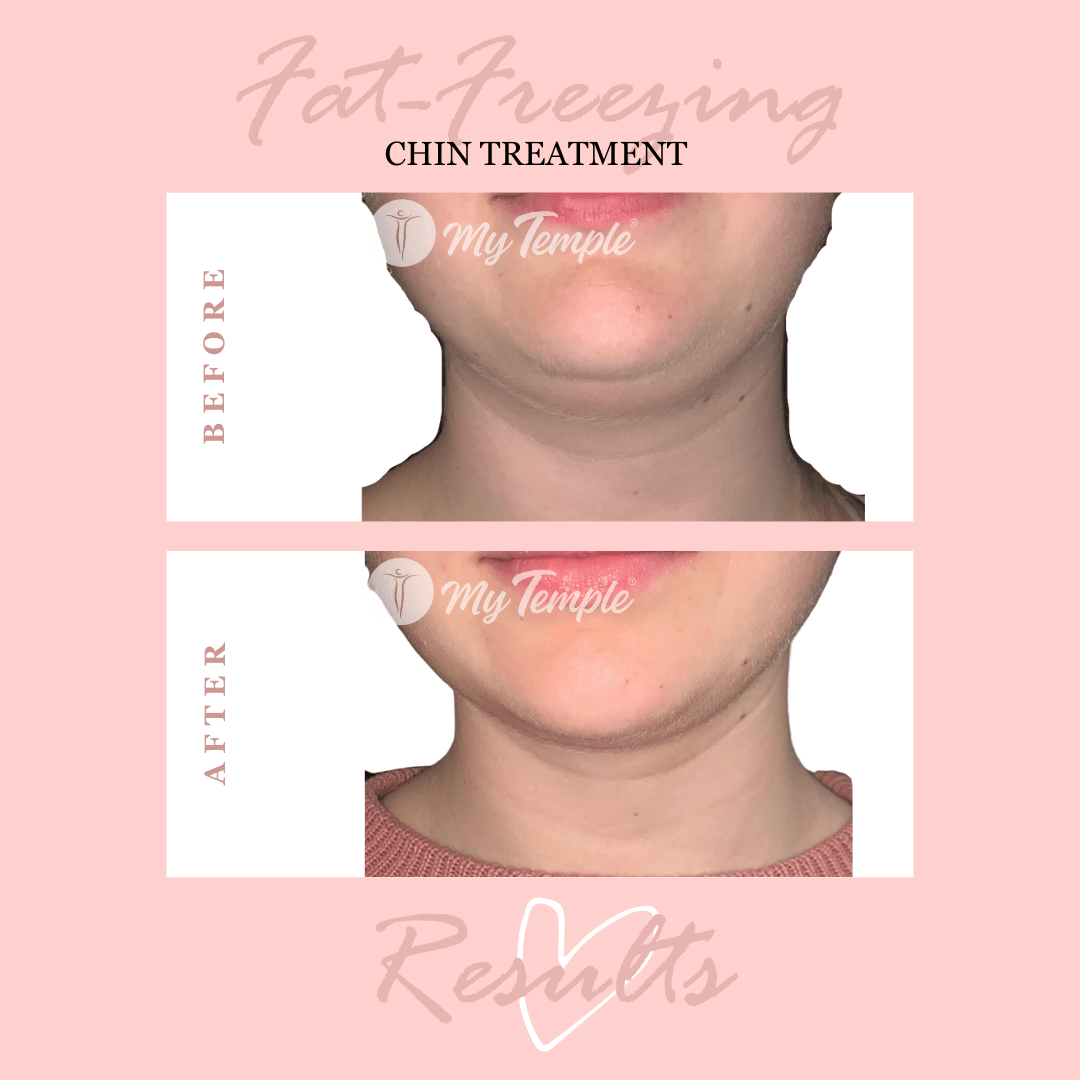 Chin treatment .png