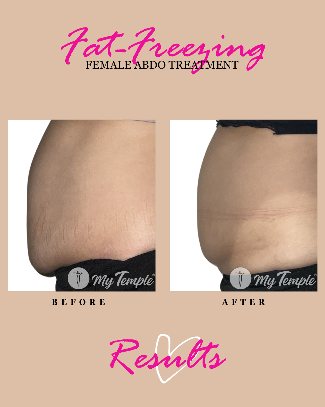 Fat freezing results: female abdomen, before and after.