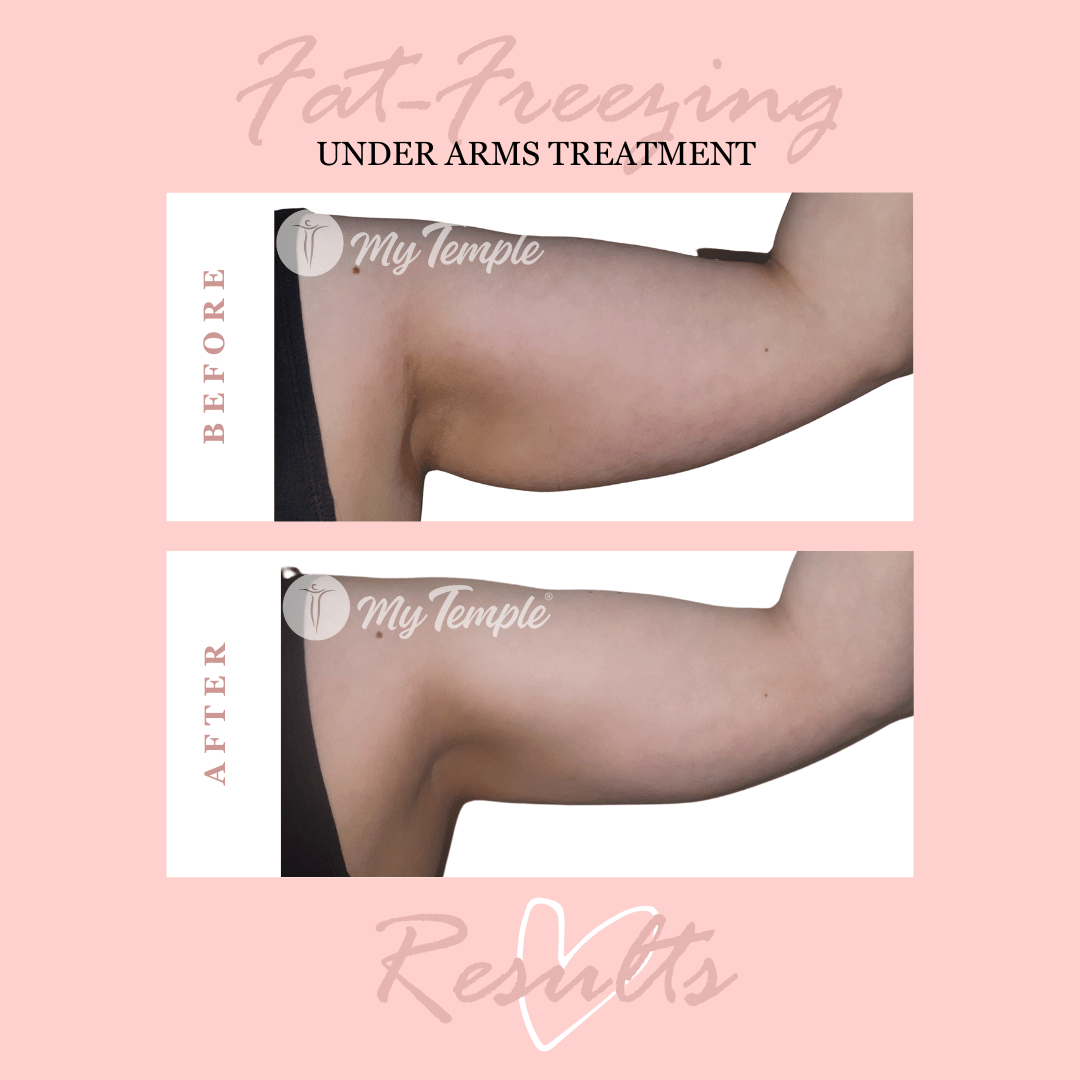 Melissa Arms 2 handles.png