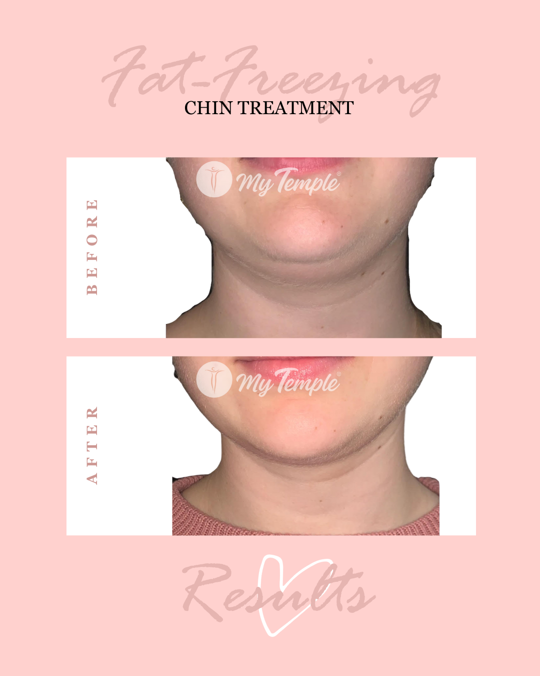 Chin treatment 4x5.png