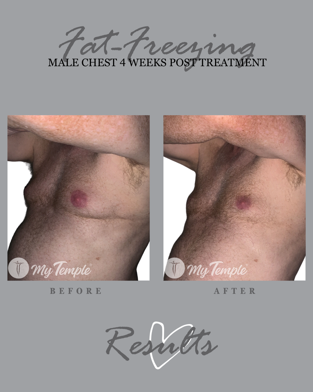 mens chest fat freezing