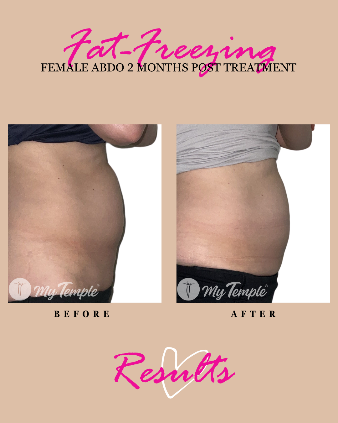 Fat freezing results: female abdomen, side view, 2 months post treatment.