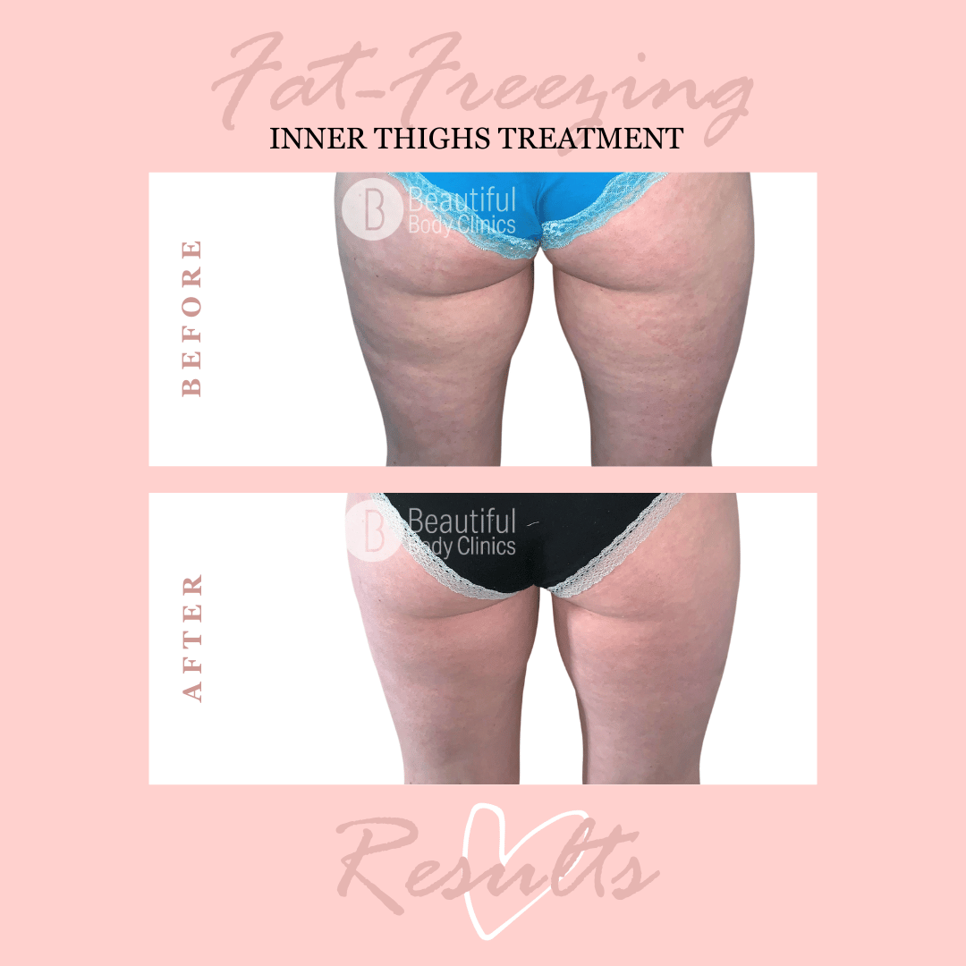 Inner thighs 2.png