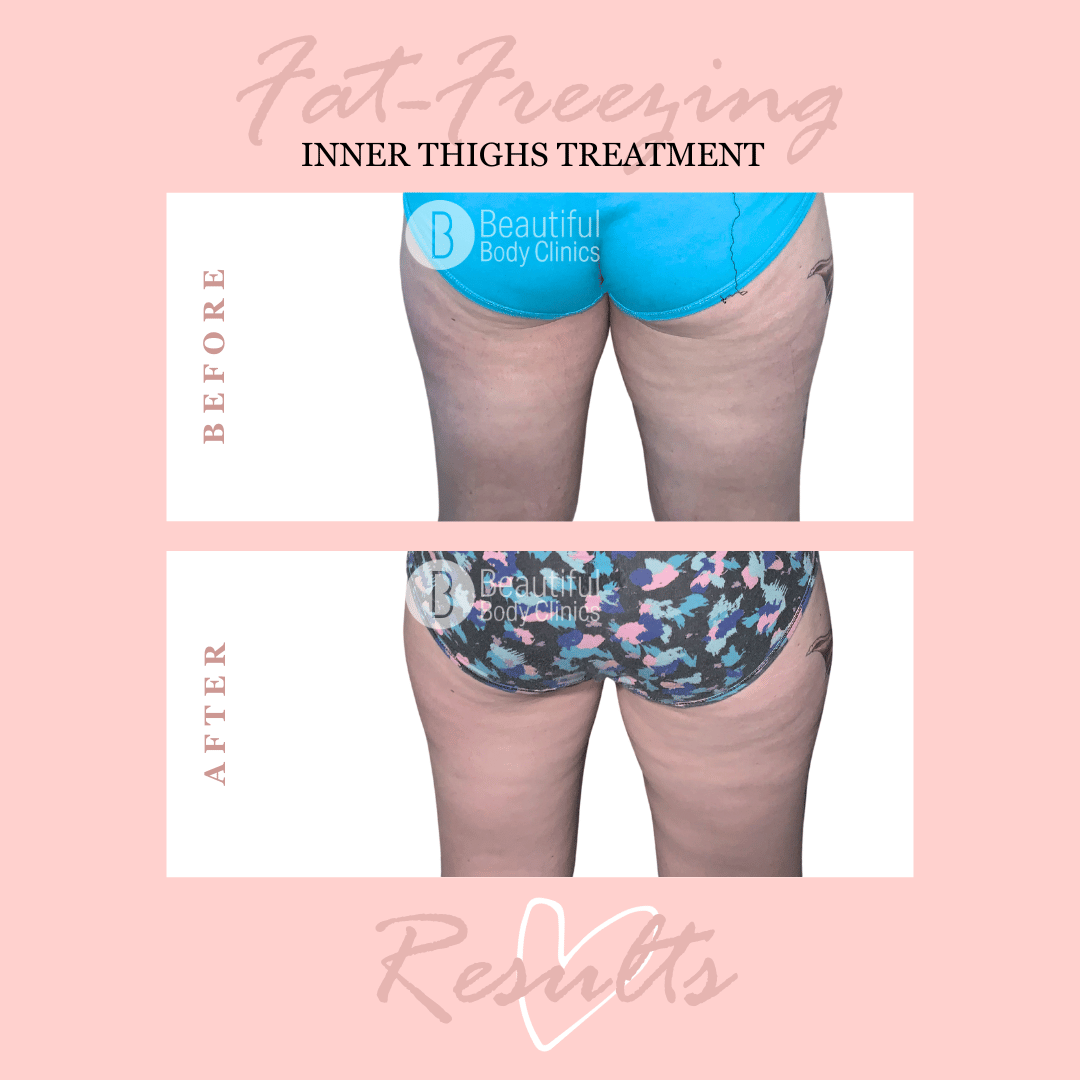 Inner thighs treatment 2.png
