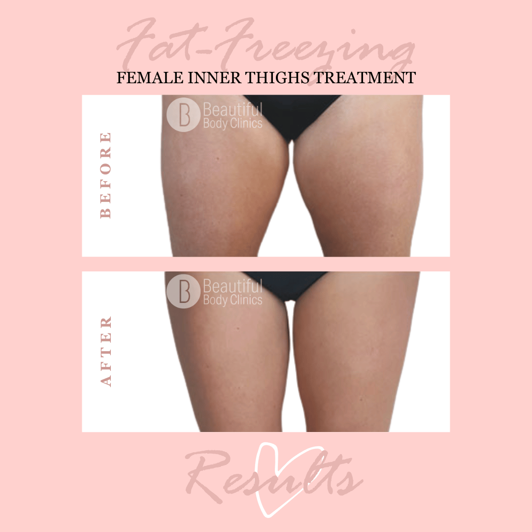 inner thighs 2 handles.png