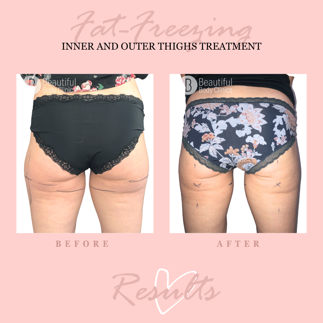 VK inner and outer thighs (1).png