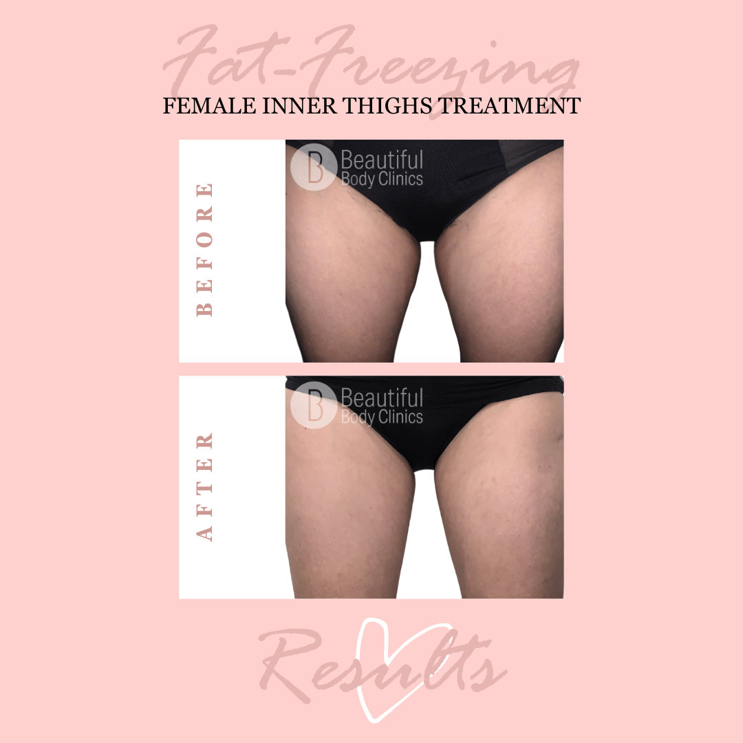 Robyn Follett inner thighs (1).png