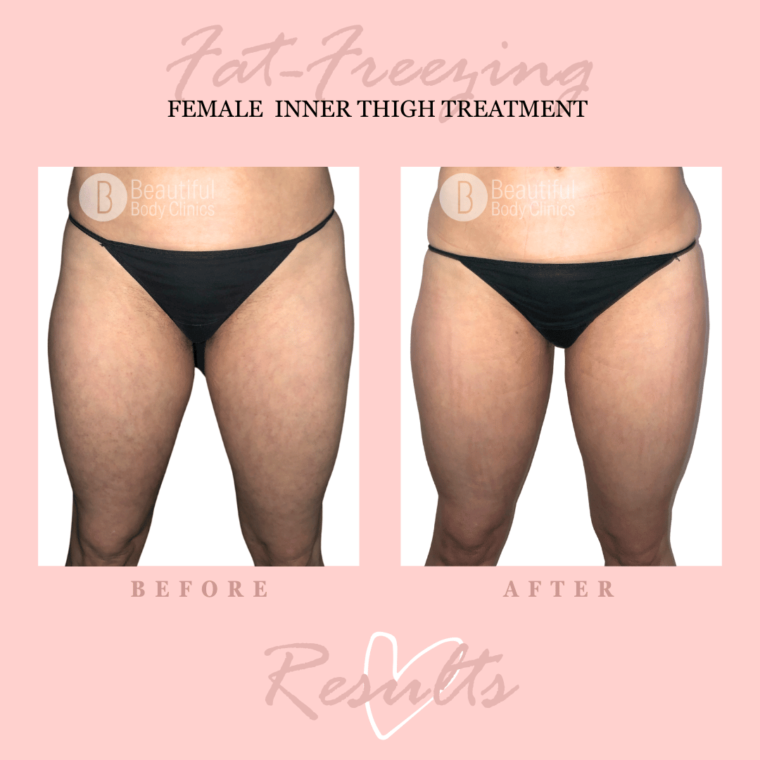 RF Inner Thigh 23.png