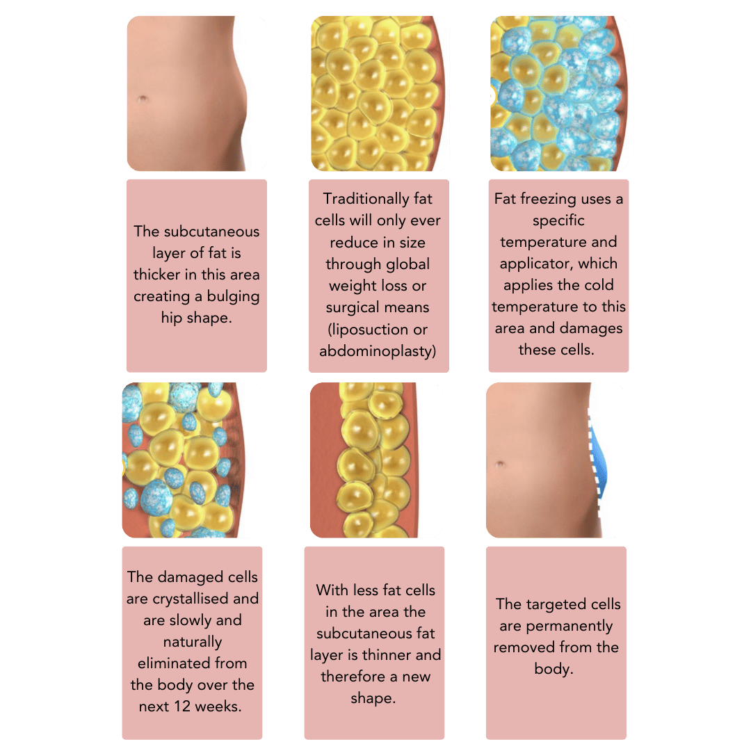 Infographic+How+does+fat+freezing+works+(Instagram+Post)+(2).png?format=2500w