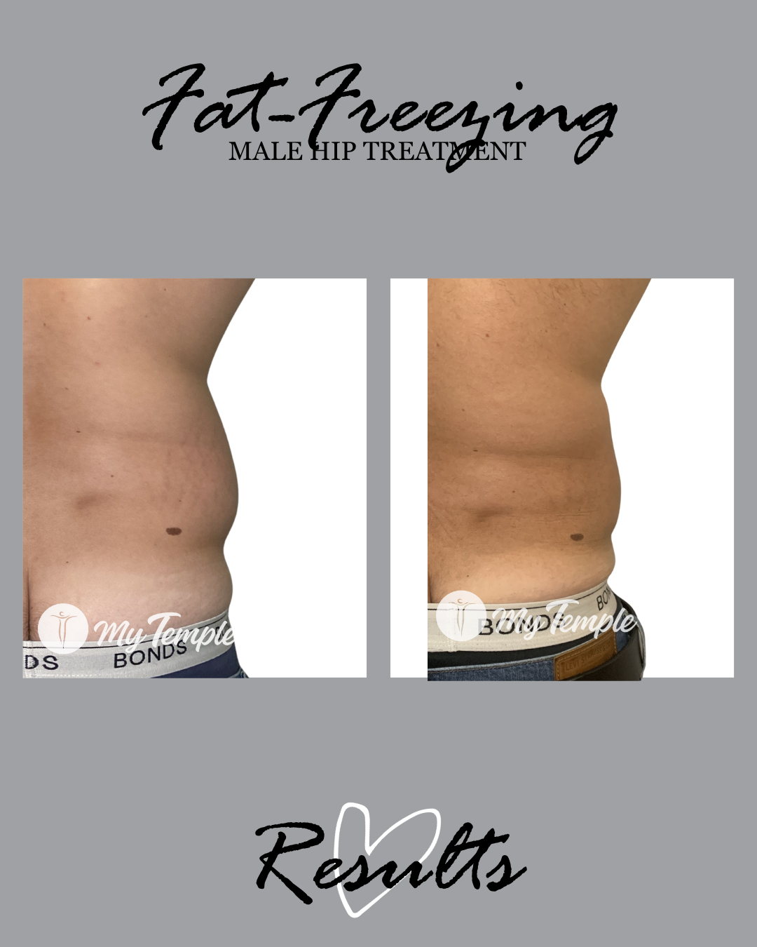 fat frreexing mans hips love handles