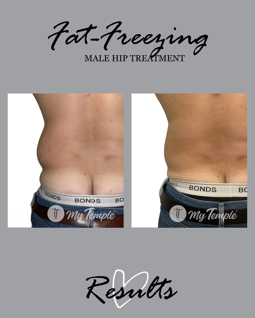 fat freezing mens hips