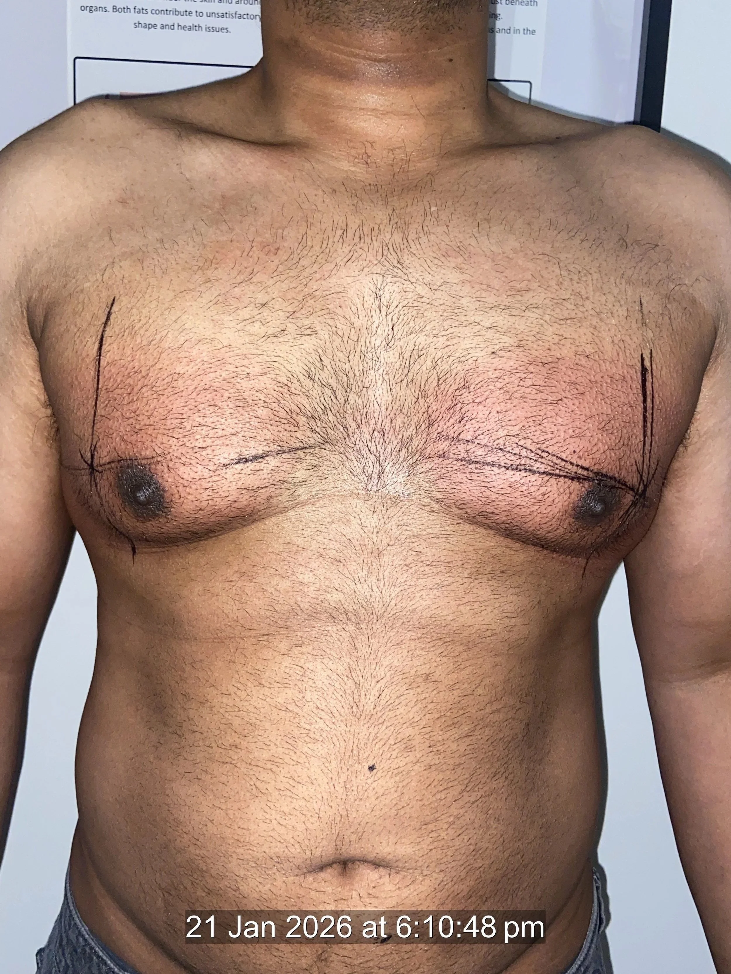 mens chest fat freezing