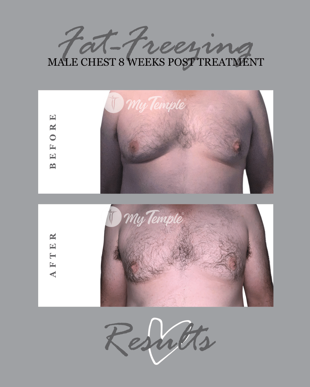Male chest (Moobs) fat freezing results at 8 weeks post treatment