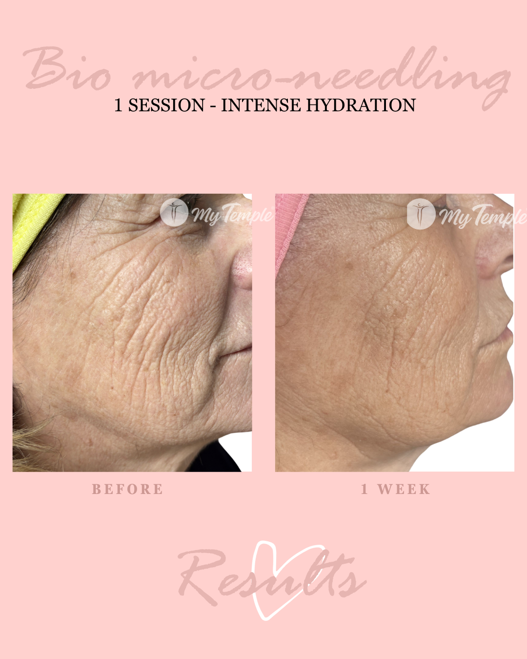 Spicule microneedling creating millions of microchannels for intense hydration