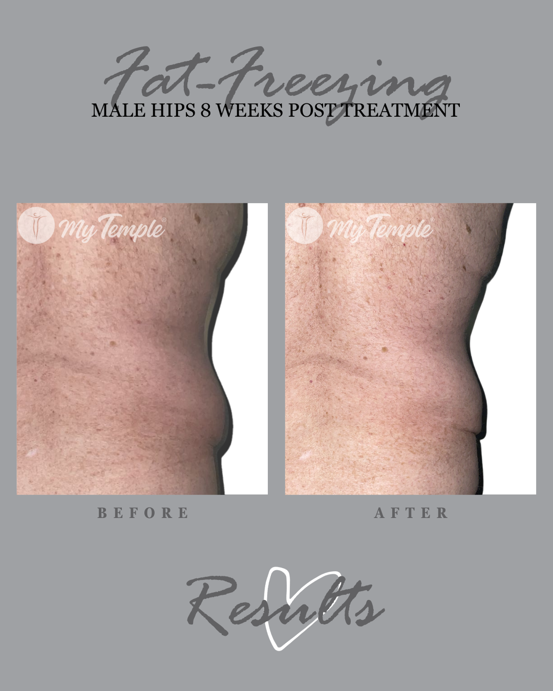 Robert B hips @2months 4x5.png