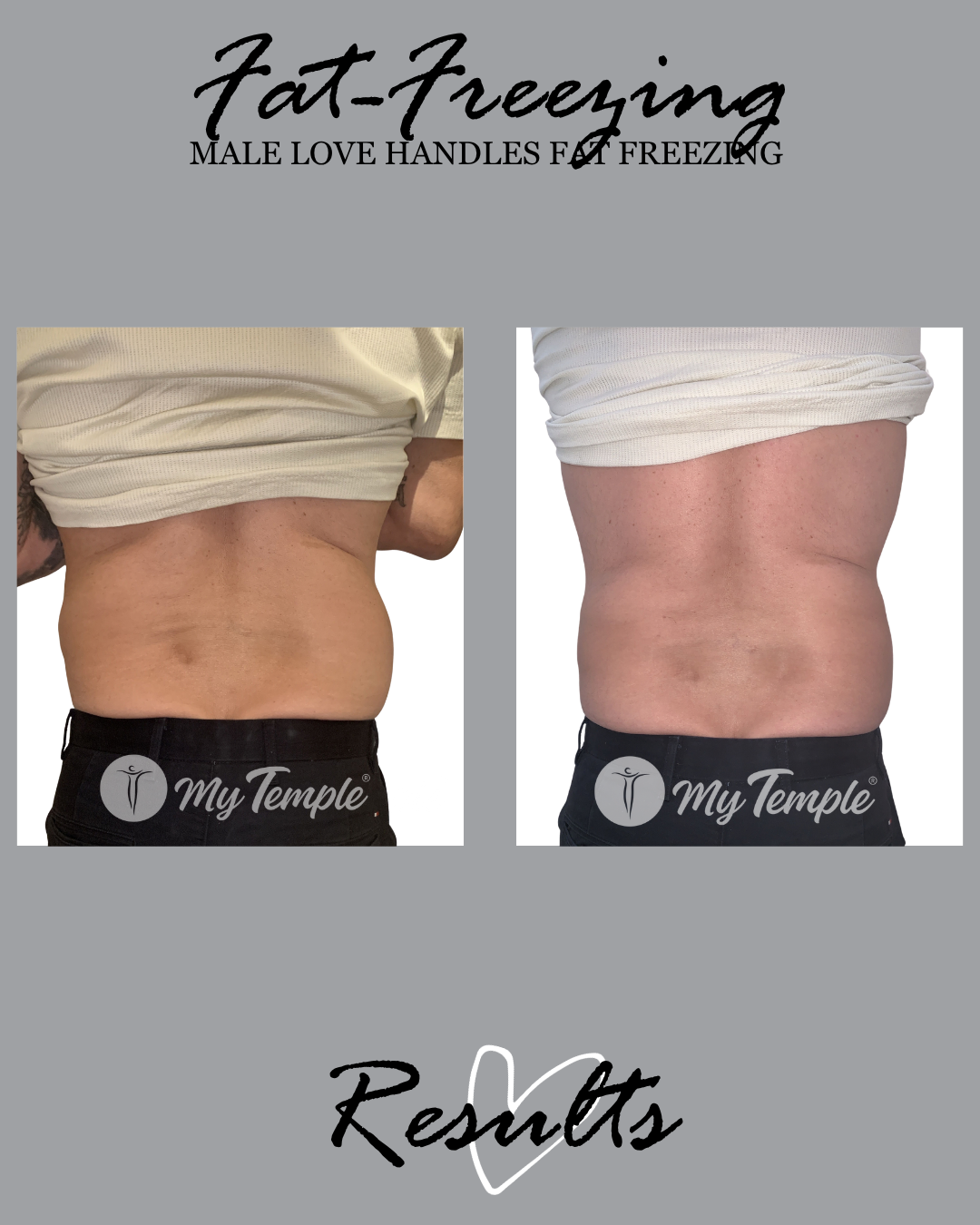 love handles fat freezing result